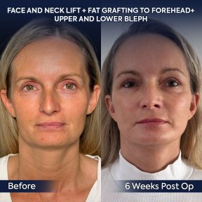 Premium Face&Neck lift + Upper Blephasroplasty+ Fat Transfer to Face Surgery -All Incluisive with European Board Certified Doctor Ali Sadioglu - photo 3