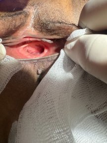 Premium Hymenoplasty (hymen restoration) 1 night hotel stay, transfers included.