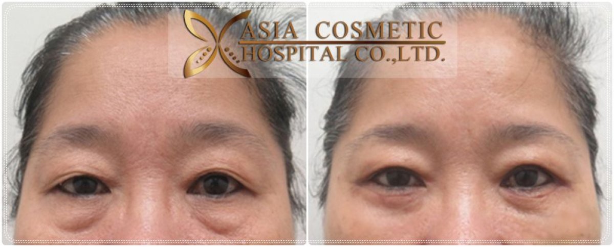 Before and after upper and lower eyelid surgery results at Asia Cosmetic Hospital