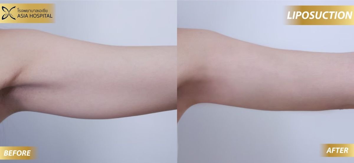 Before and after Vaser liposuction results on arm at Asia Cosmetic Hospital, slimmer contour