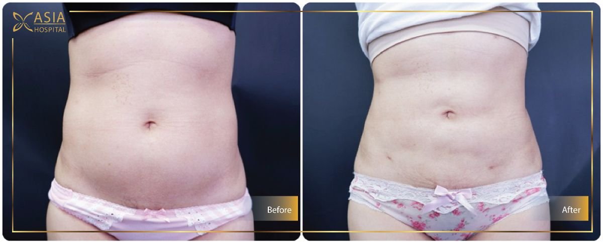 Before and after Vaser liposuction results at Asia Cosmetic Hospital, abdomen contour improvement