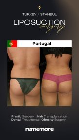 Standard 360 Liposuction with All Included