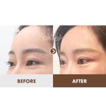 Before and after Blepharoplasty (Eyelid correction) photos by Dr. Tak Seung Wan 