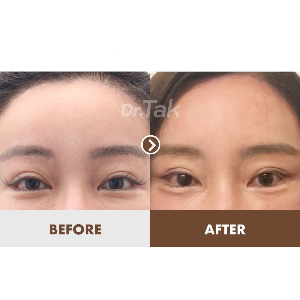 نتائج قبل وبعد Fox Eye Lift في Dr. Tak Plastic Surgery، مظهر جفن مرفوع