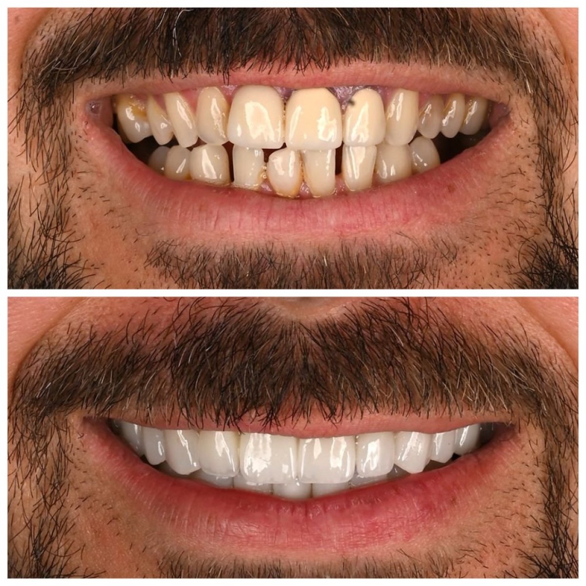 Antes y después de carillas dentales en Soraca Med, sonrisa más blanca y uniforme