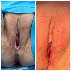 Premium Vaginoplasty with cystocele-rectocel-enterocel repair, vaginal thread tightening, O shot, vulvar filling