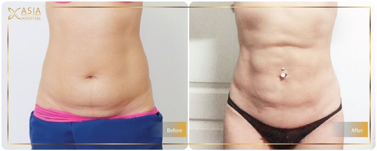 Before and after 360 liposuction results at Asia Cosmetic Hospital, visible body contouring