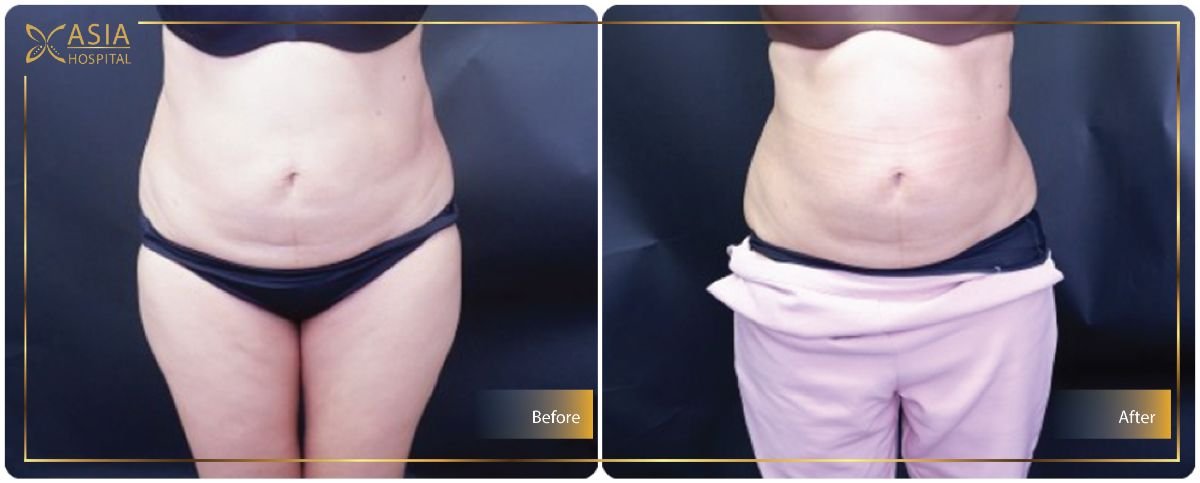 Before and after 360 liposuction results at Asia Cosmetic Hospital, visible body contouring