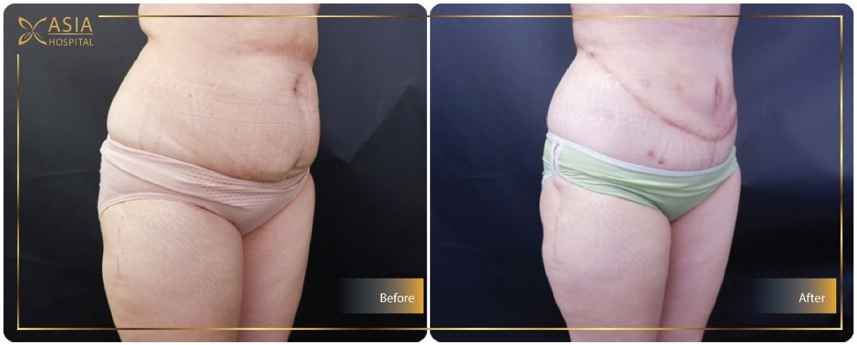 Before and after 360 liposuction results at Asia Cosmetic Hospital, visible body contouring