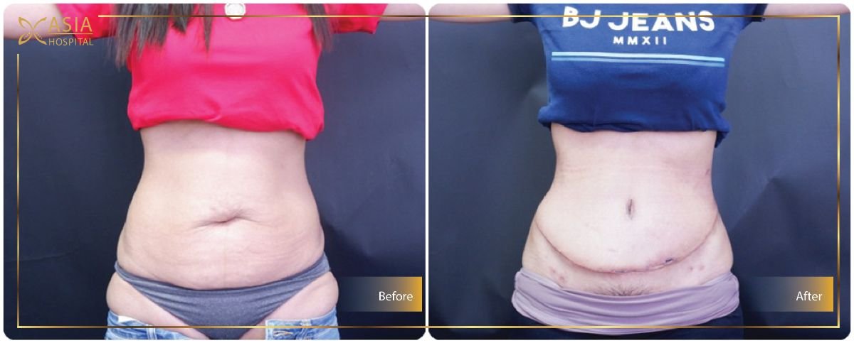 Before and after 360 liposuction results at Asia Cosmetic Hospital, improved abdominal contour