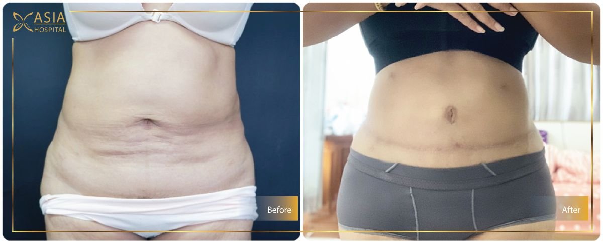 Before and after 360 liposuction results at Asia Cosmetic Hospital, visible waist contouring