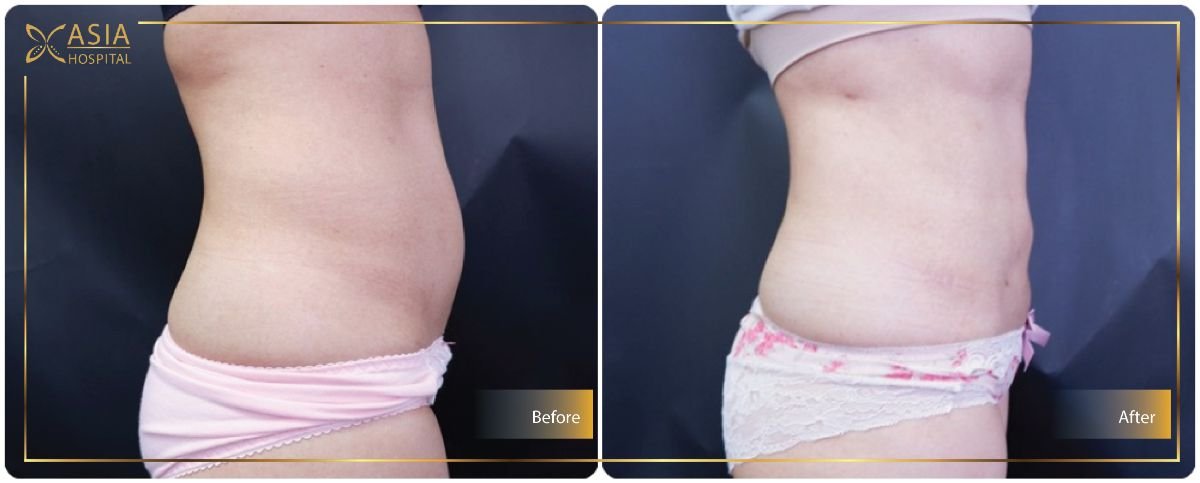 Before and after 360 liposuction results at Asia Cosmetic Hospital, improved body contour