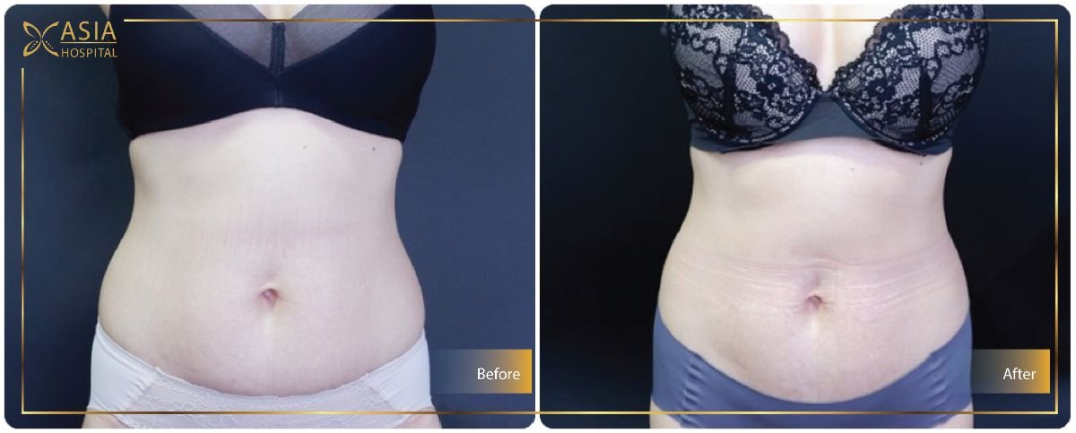 360 liposuction before and after results at Asia Cosmetic Hospital, visible waist contouring