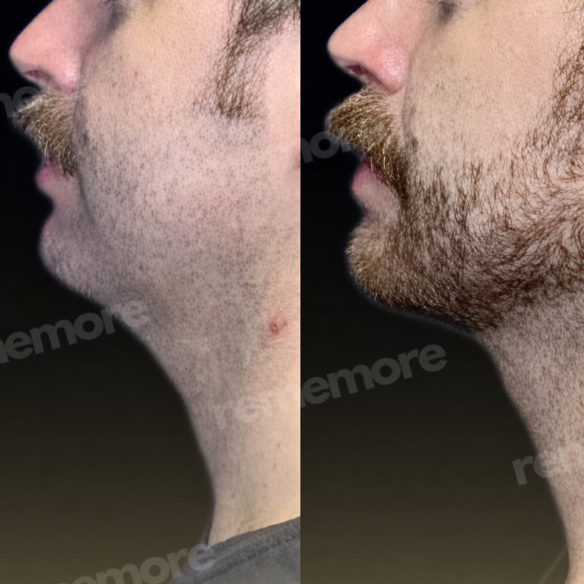 Resultados antes y después de perfilado mandibular en Memorial Bahçelievler Hospital, mentón mejorado