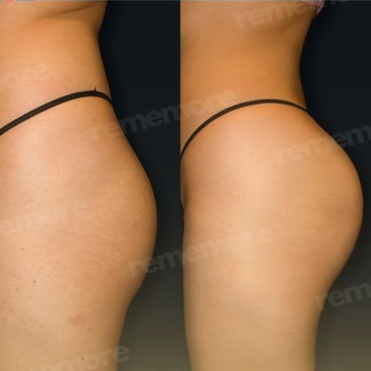 Результаты до и после Brazilian Butt Lift в Memorial Bahçelievler Hospital, улучшенный контур