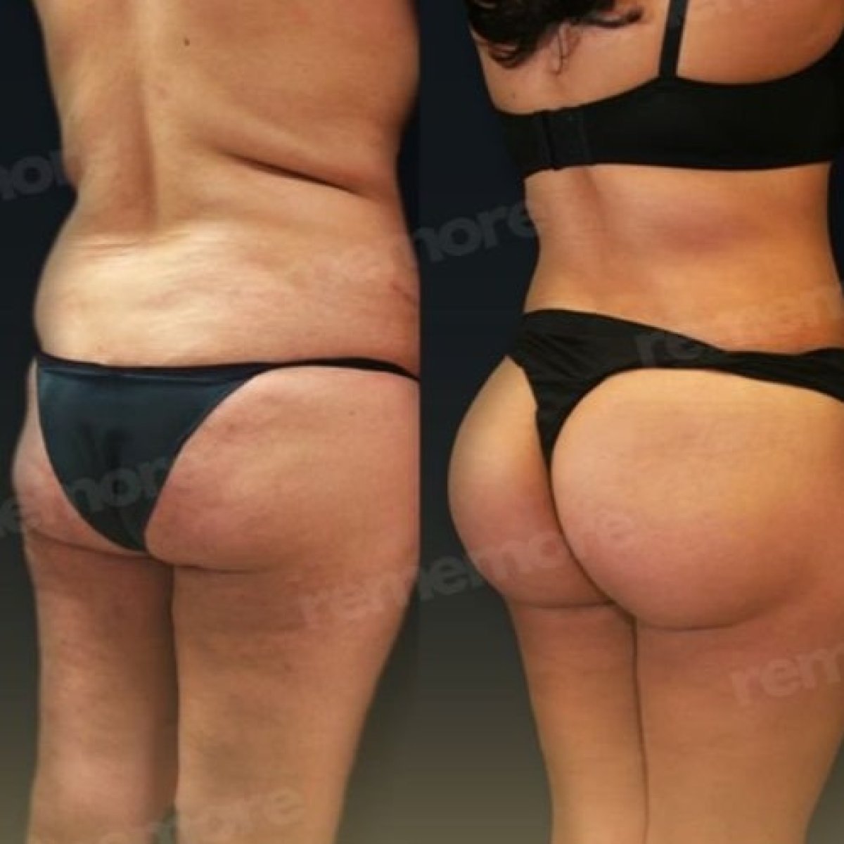 Результаты до и после Brazilian Butt Lift в Memorial Bahçelievler Hospital, контур тела