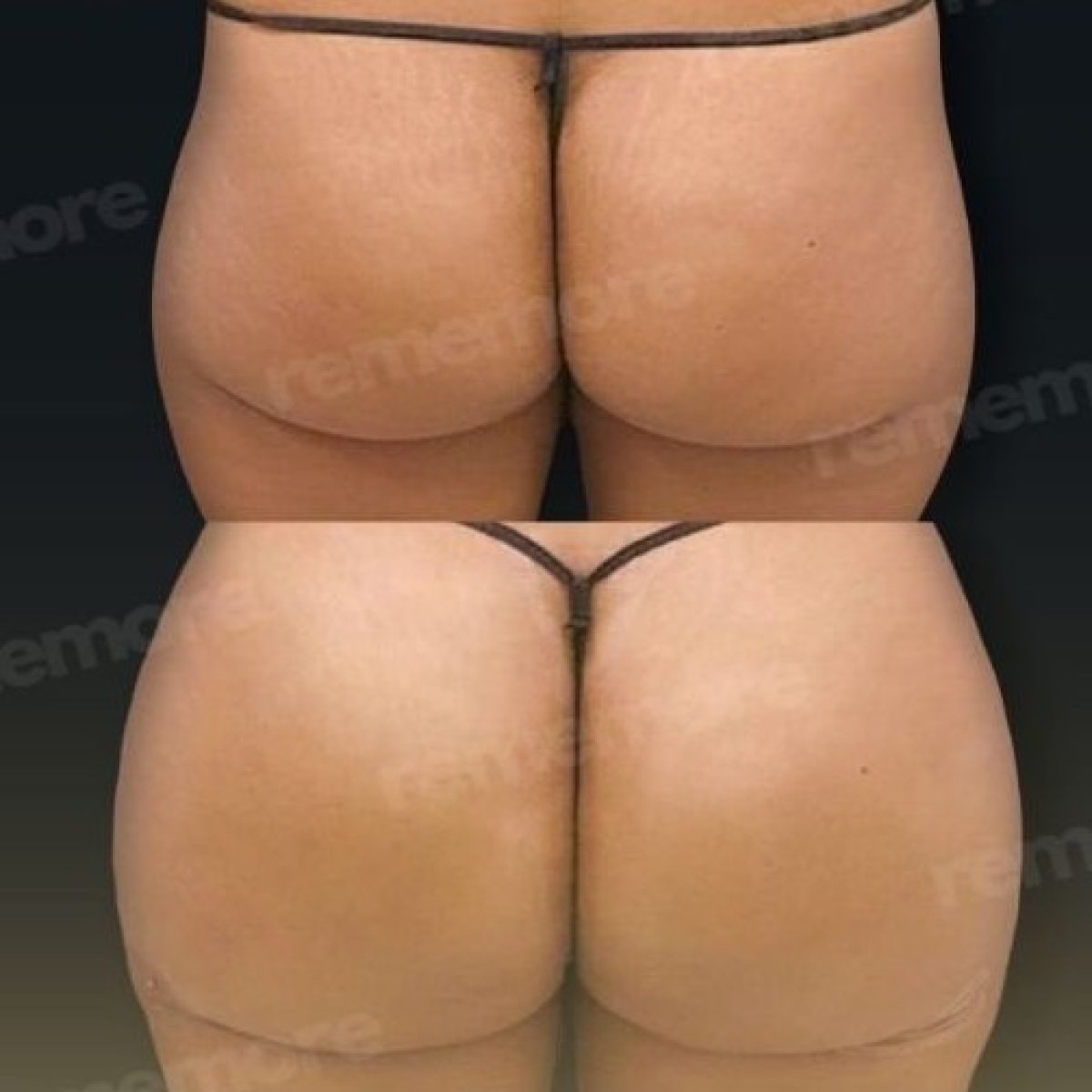 نتائج قبل وبعد عملية Brazilian Butt Lift في مستشفى Memorial Bahçelievler، تحسين الشكل