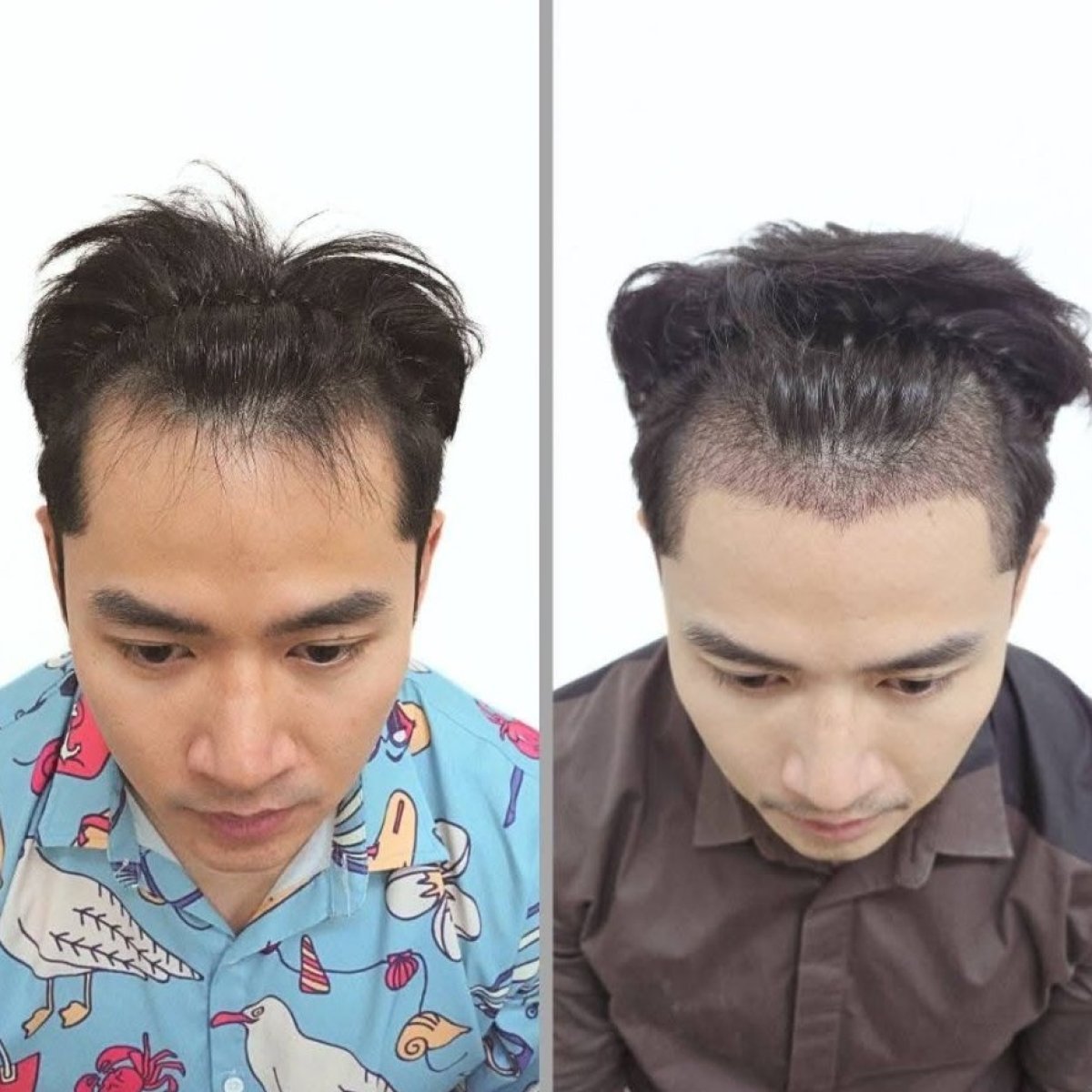 نتيجة قبل وبعد زراعة الشعر في عيادة Dr.Nutt، استعادة خط الشعر