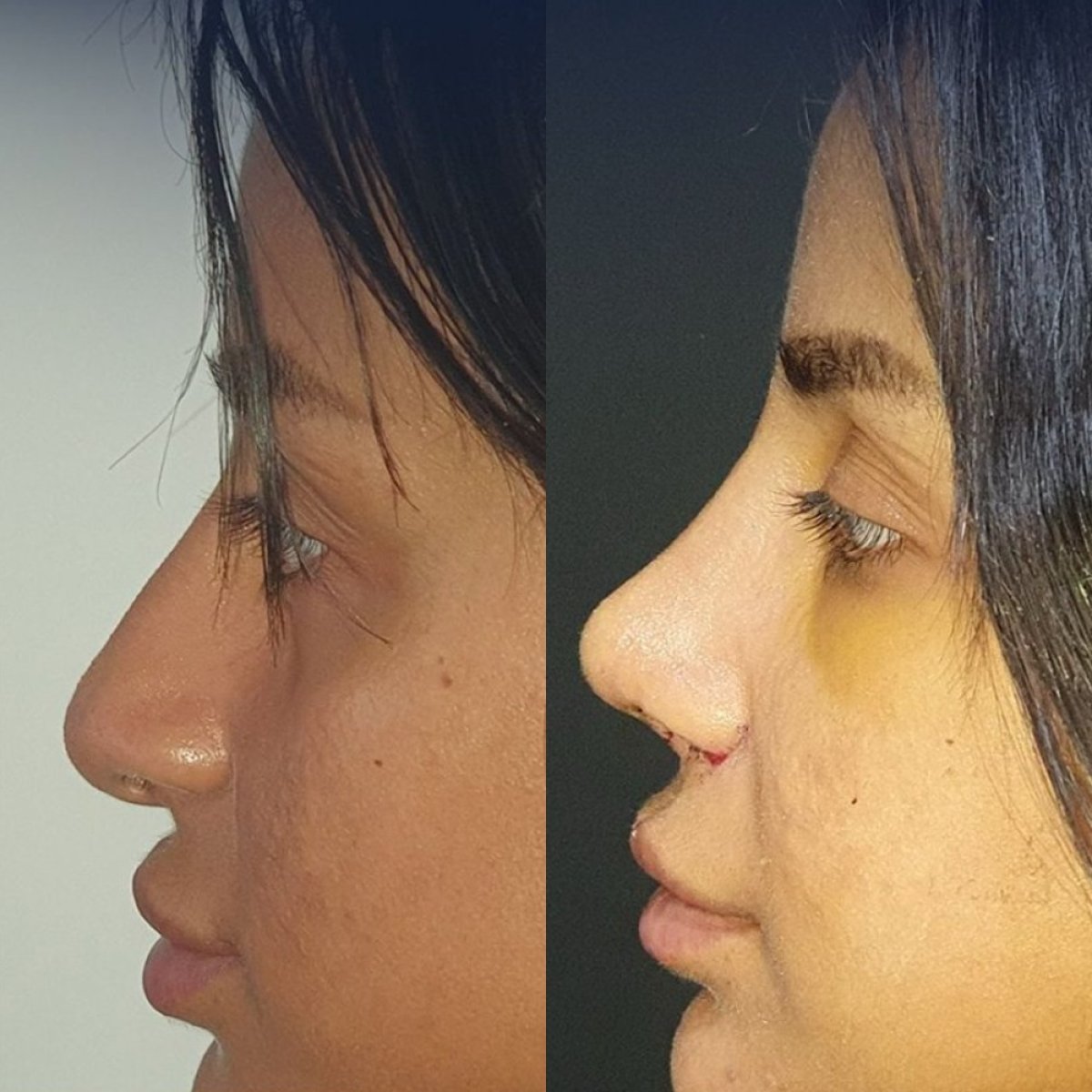 Resultados antes y después de rinoplastia étnica en Dr. Safa Manav Clinic, remodelación nasal