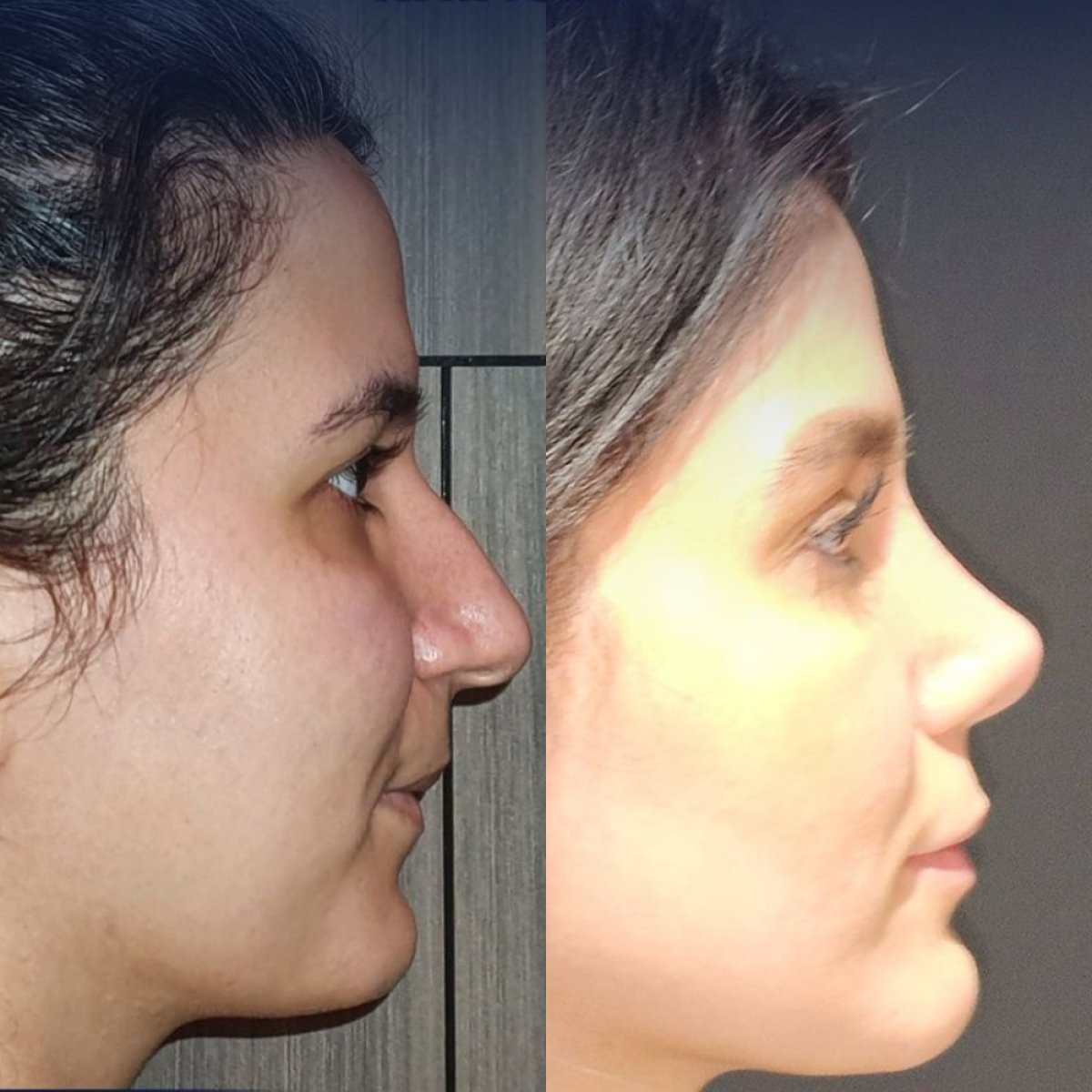 Resultados antes y después de rinoplastia étnica en Dr. Safa Manav Clinic, remodelación nasal