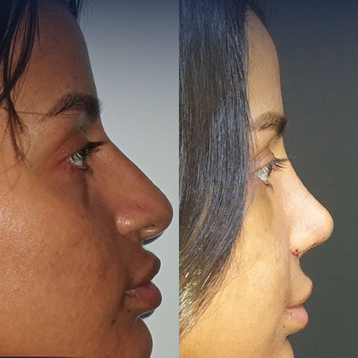 Resultados antes y después de rinoplastia étnica en Dr. Safa Manav Clinic, remodelación nasal