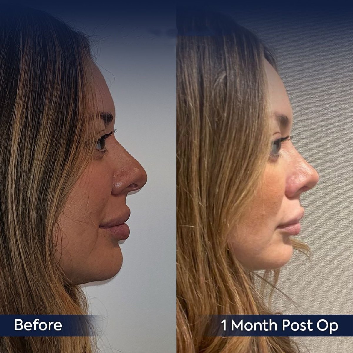 Resultados de rinoplastia antes y después en Dr. Safa Manav Clinic, perfil nasal mejorado
