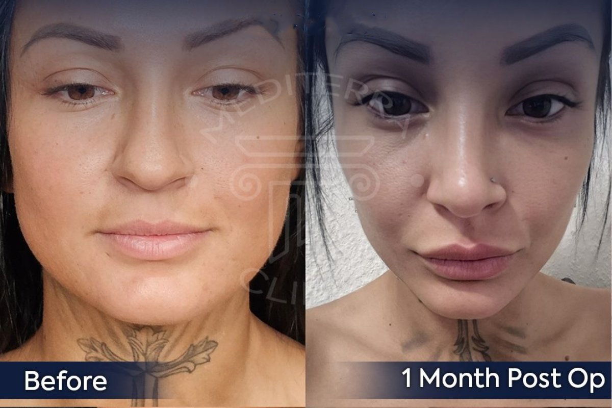 Resultados de rinoplastia étnica antes y después en Dr. Safa Manav Clinic, cambio de nariz