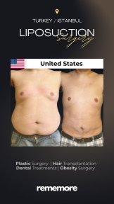 Standard Full Body Lift with All Included
