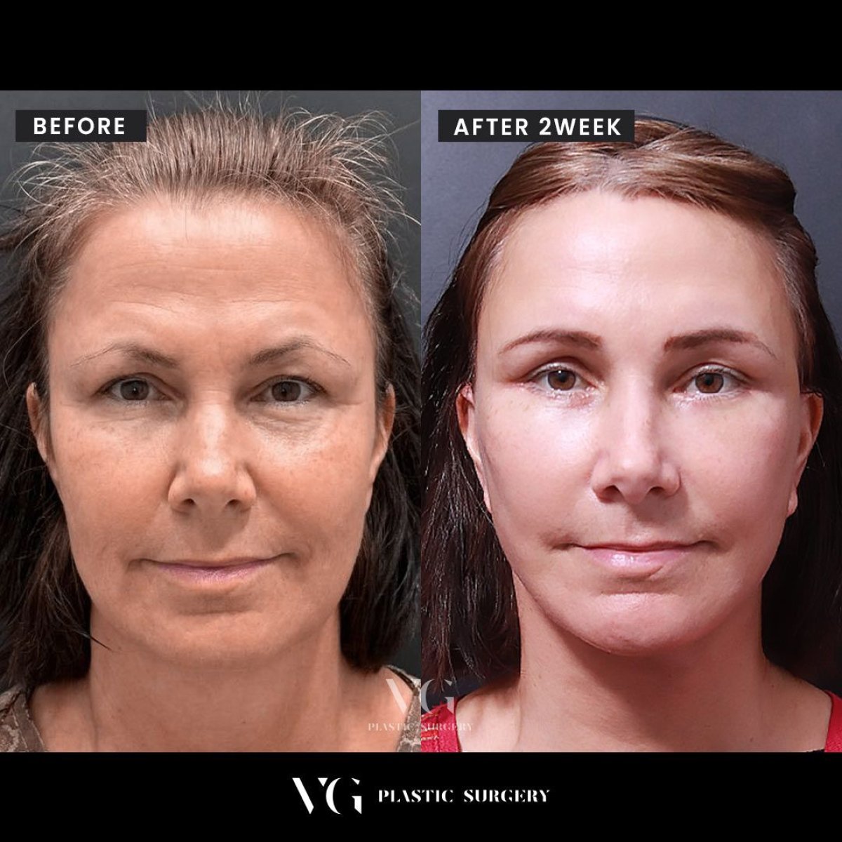 Результати ендоскопічної підтяжки обличчя до і після у VG Plastic Surgery, омолодження