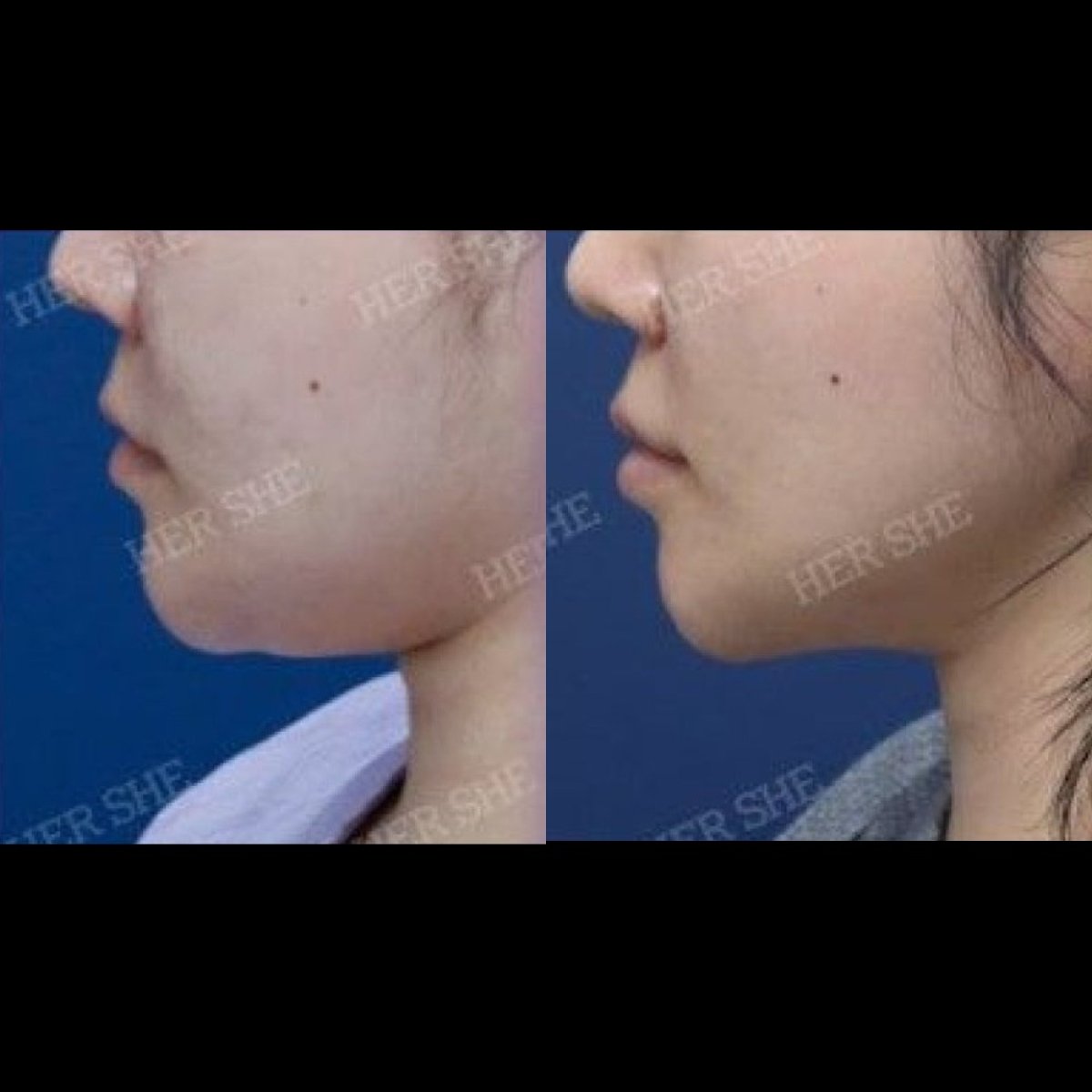 Efekty przeszczepu tłuszczu w twarzy przed i po w HERSHE Plastic Surgery Korea, lepszy kontur