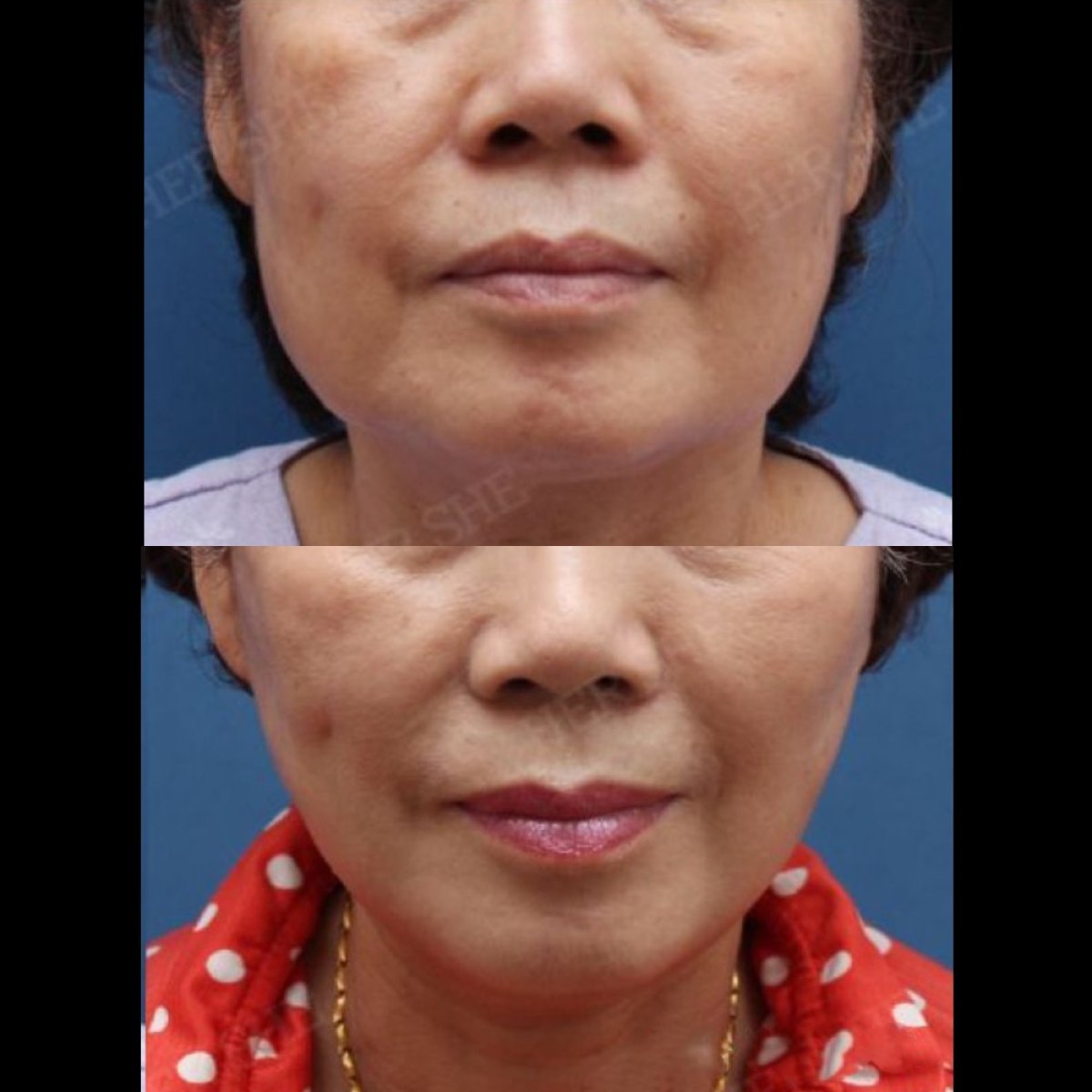 نتائج شد الوجه العميق قبل وبعد في HERSHE Plastic Surgery Korea، تجديد شباب الوجه