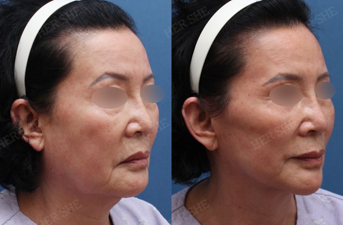 Результаты до и после deep plane SMAS лифтинга в HERSHE Plastic Surgery Korea, омоложение лица