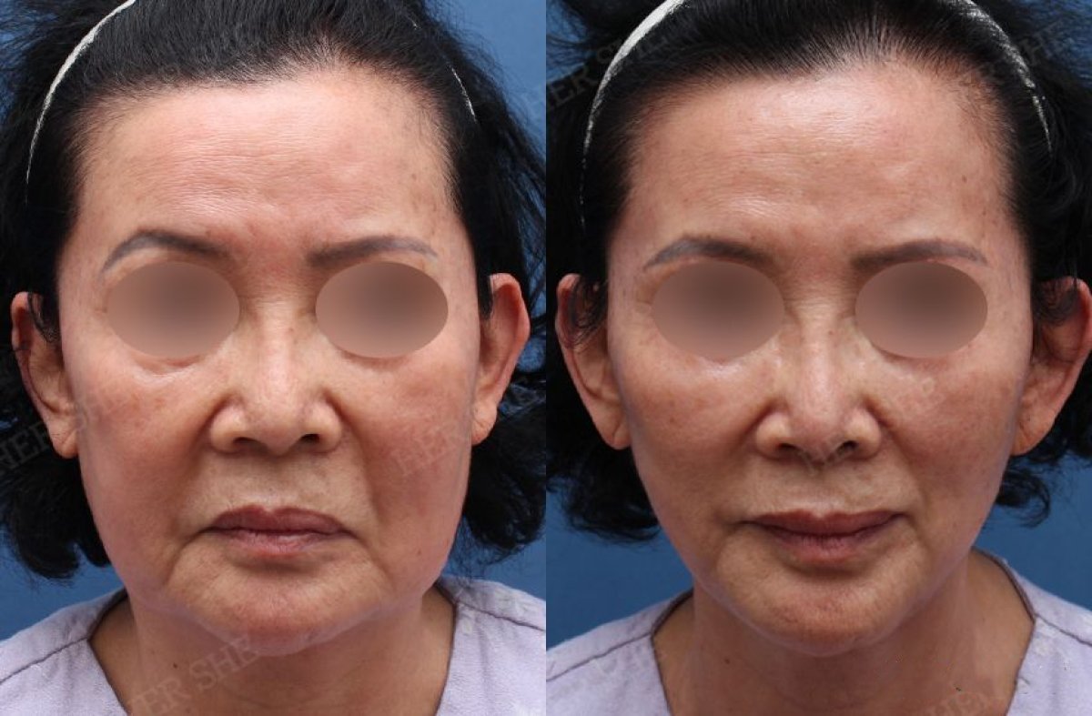 نتائج شد الوجه العميق قبل وبعد في HERSHE Plastic Surgery Korea، تجديد شباب الوجه
