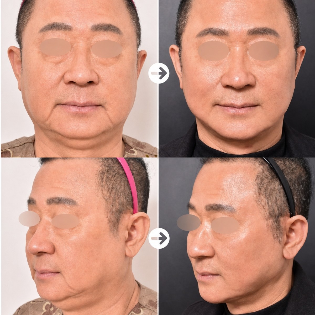 Before and after facelift results at VG Plastic Surgery, visible facial rejuvenation and contouring