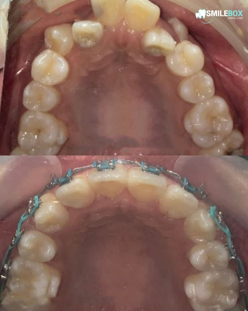 Vorher-nachher-Ergebnis Erwachsenenspange bei SmileBox Dental Clinic - Thonglor, Zahnkorrektur