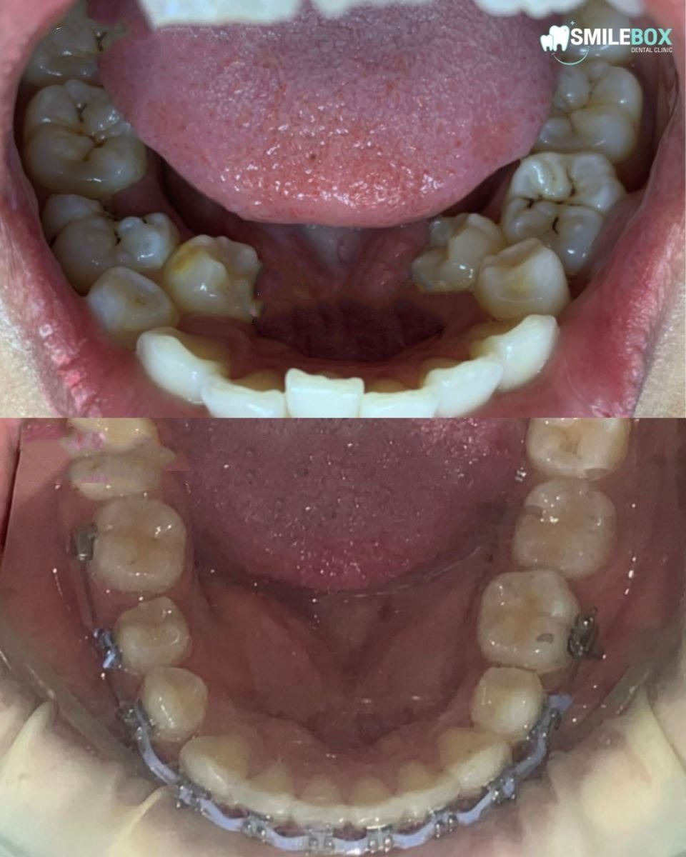 Resultados antes y después de ortodoncia para adultos en SmileBox Dental Clinic - Thonglor