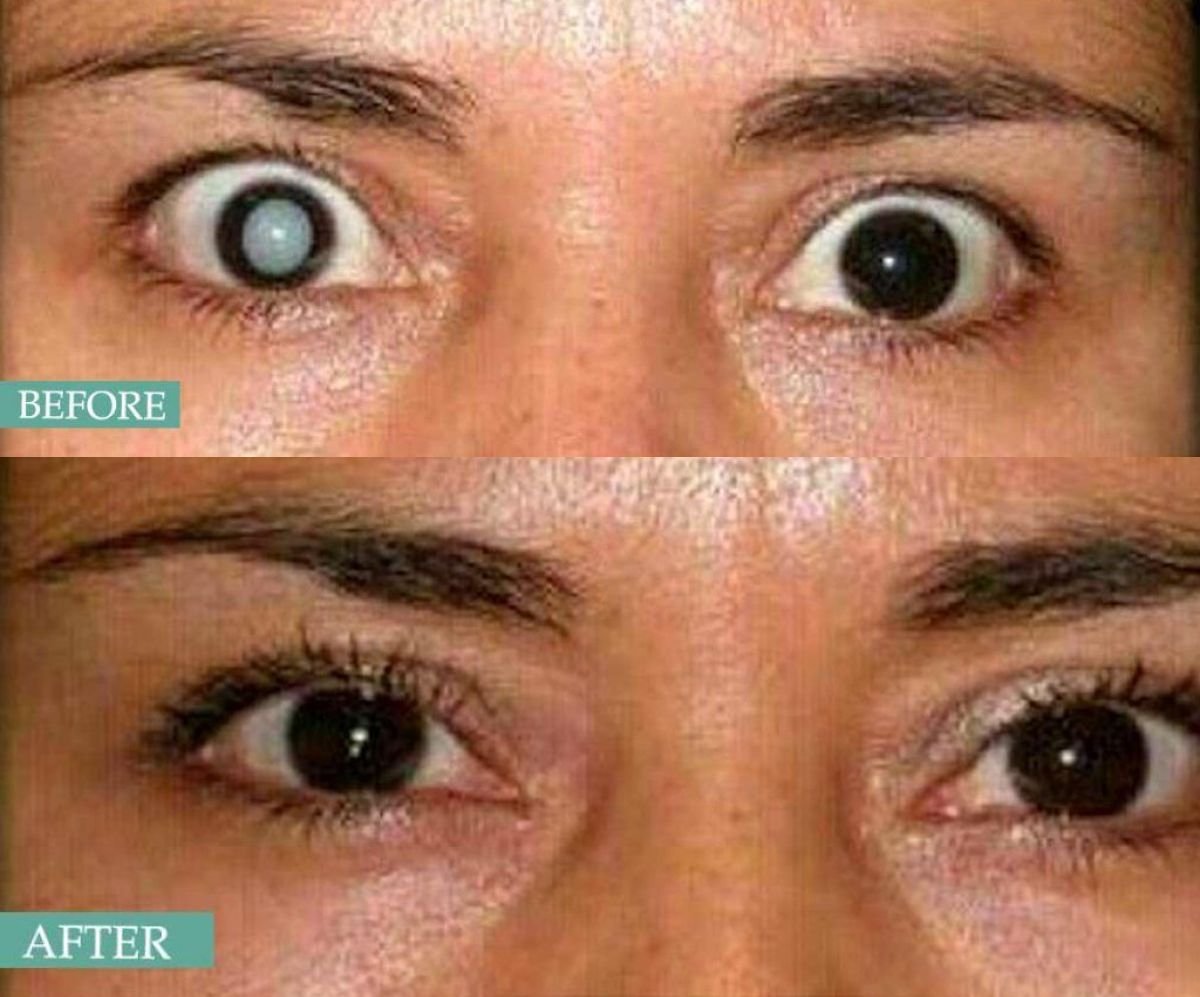 Before and after cataract surgery with multifocal lens implant at Italian Eye Hospital result