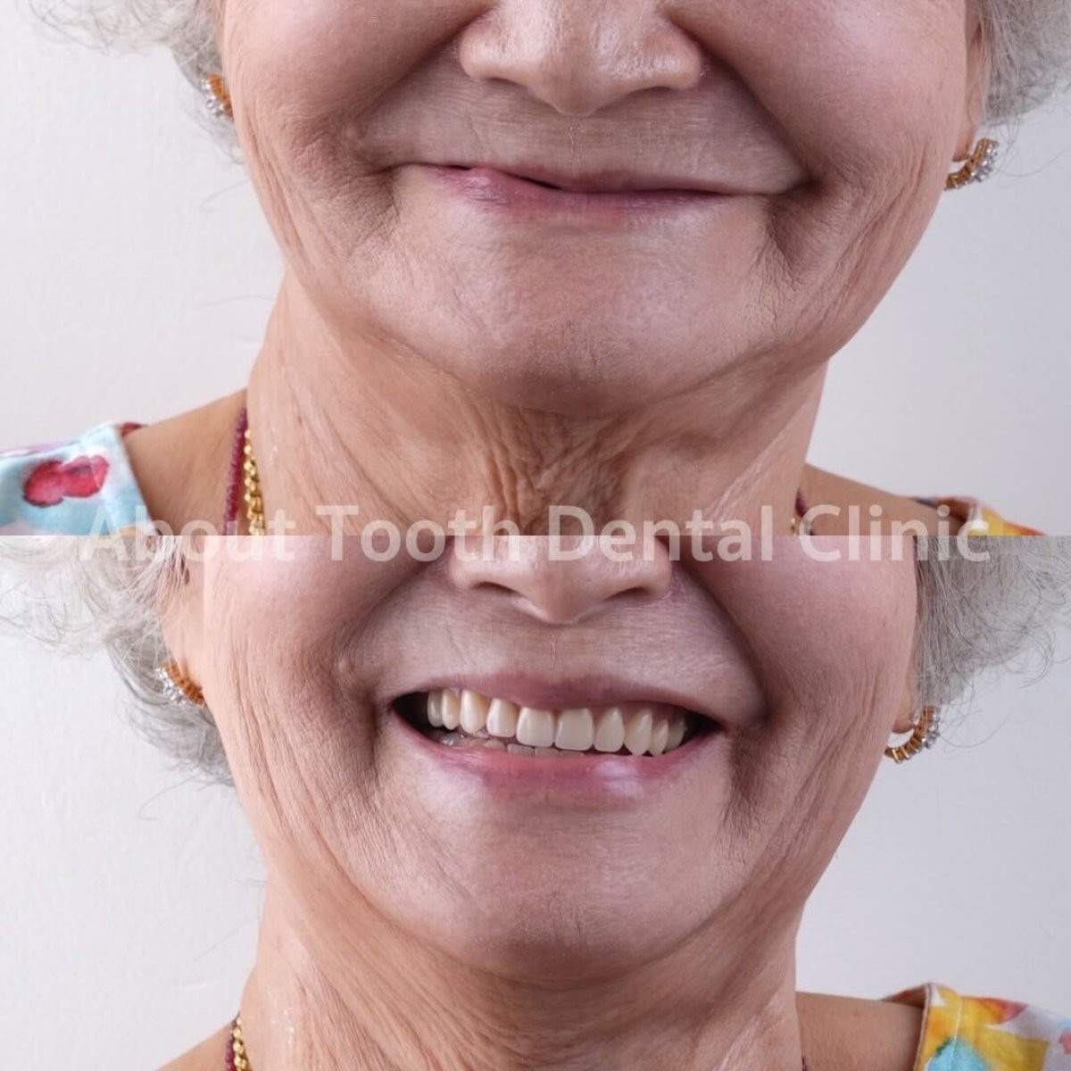 نتائج قبل وبعد طقم الأسنان في About Tooth Dental Clinic – استعادة الابتسامة المحسنة