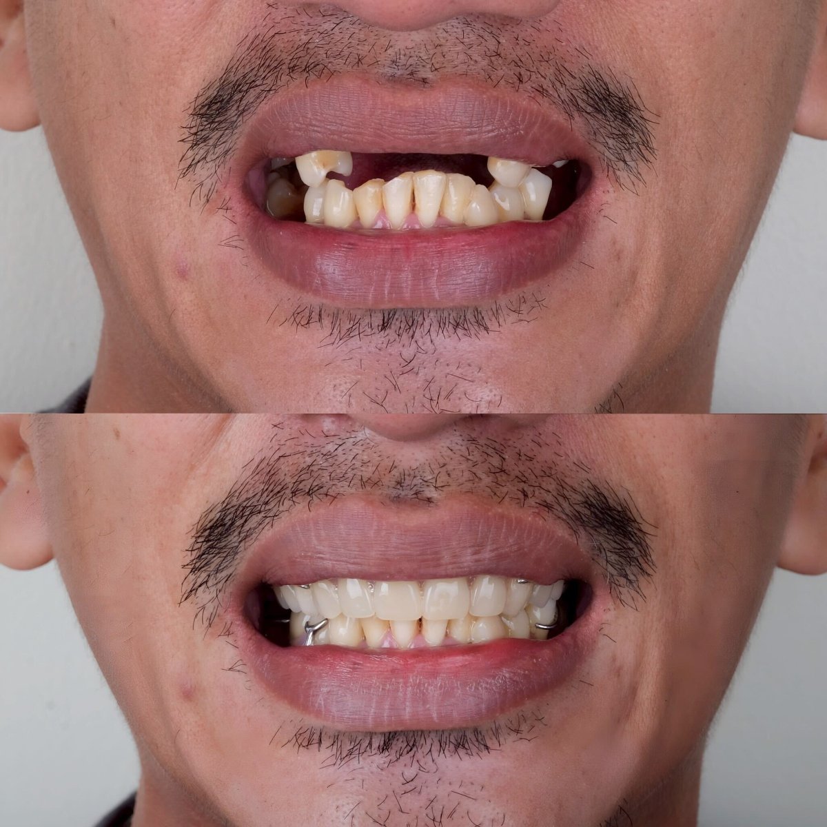 نتائج قبل وبعد طقم الأسنان في About Tooth Dental Clinic – ابتسامة مستعادة