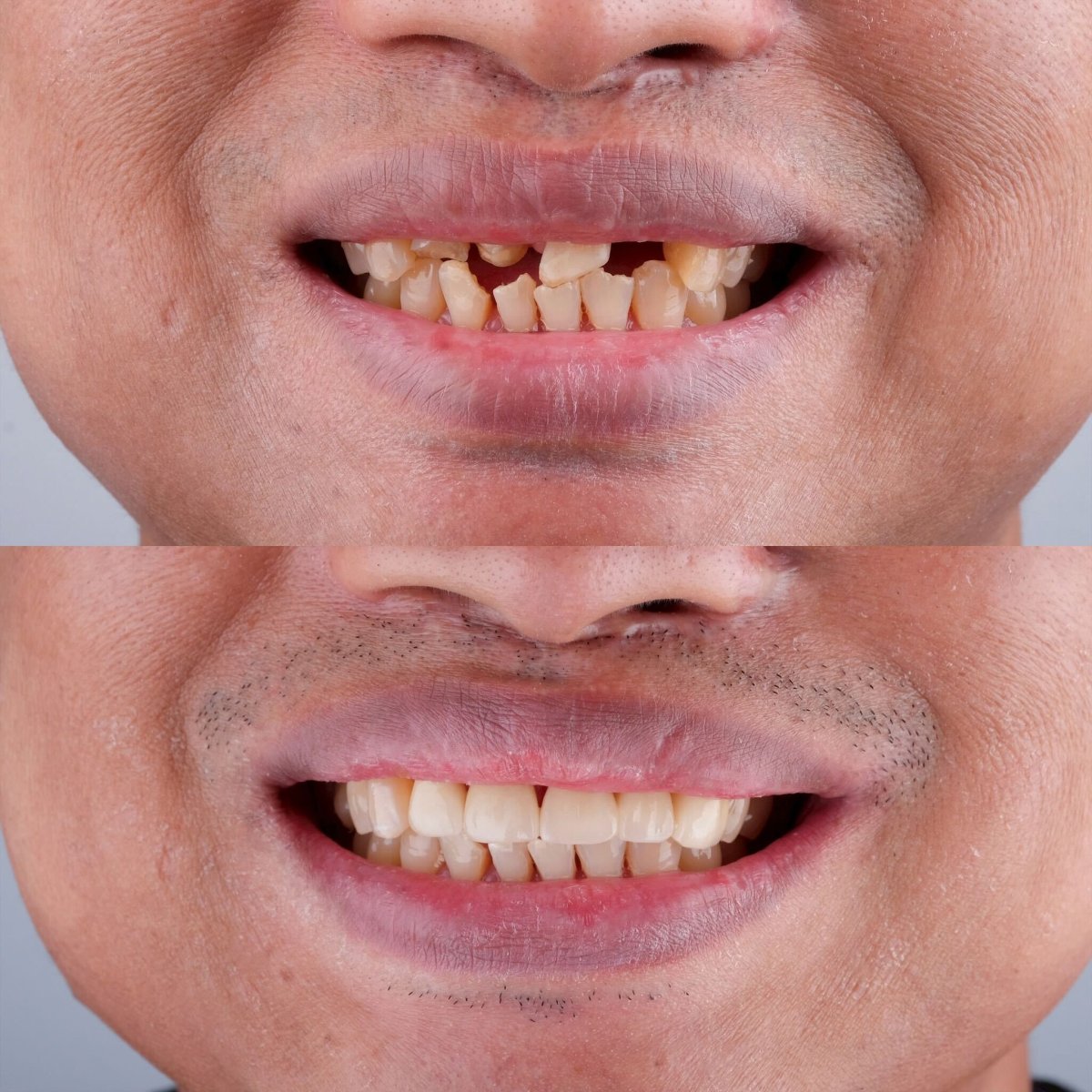 نتائج قبل وبعد طقم الأسنان في About Tooth Dental Clinic – ابتسامة ومحاذاة محسنة