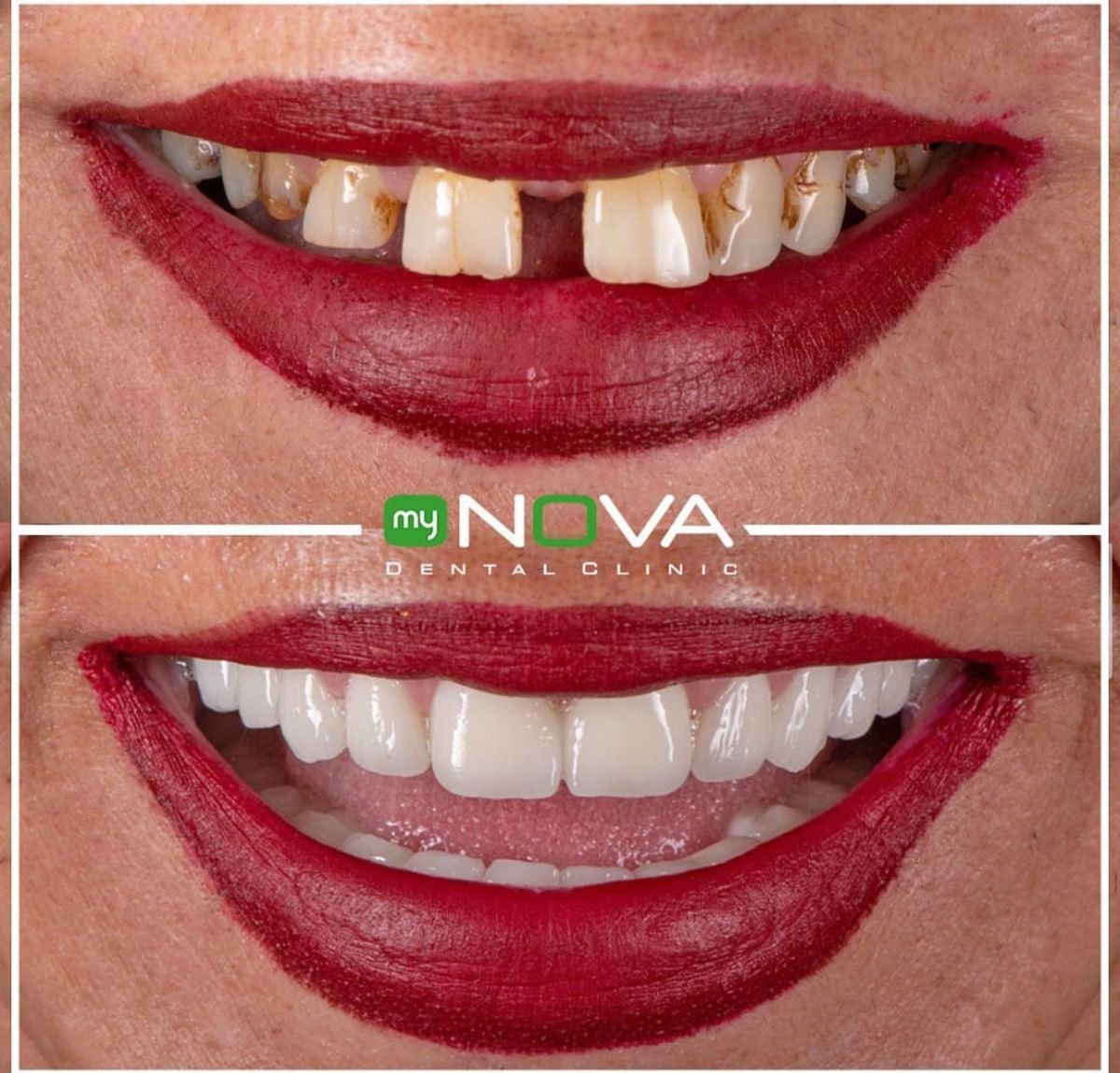 Результат до и после имплантации All-on-6 в My Nova Kusadasi Dental Clinic, преображение улыбки
