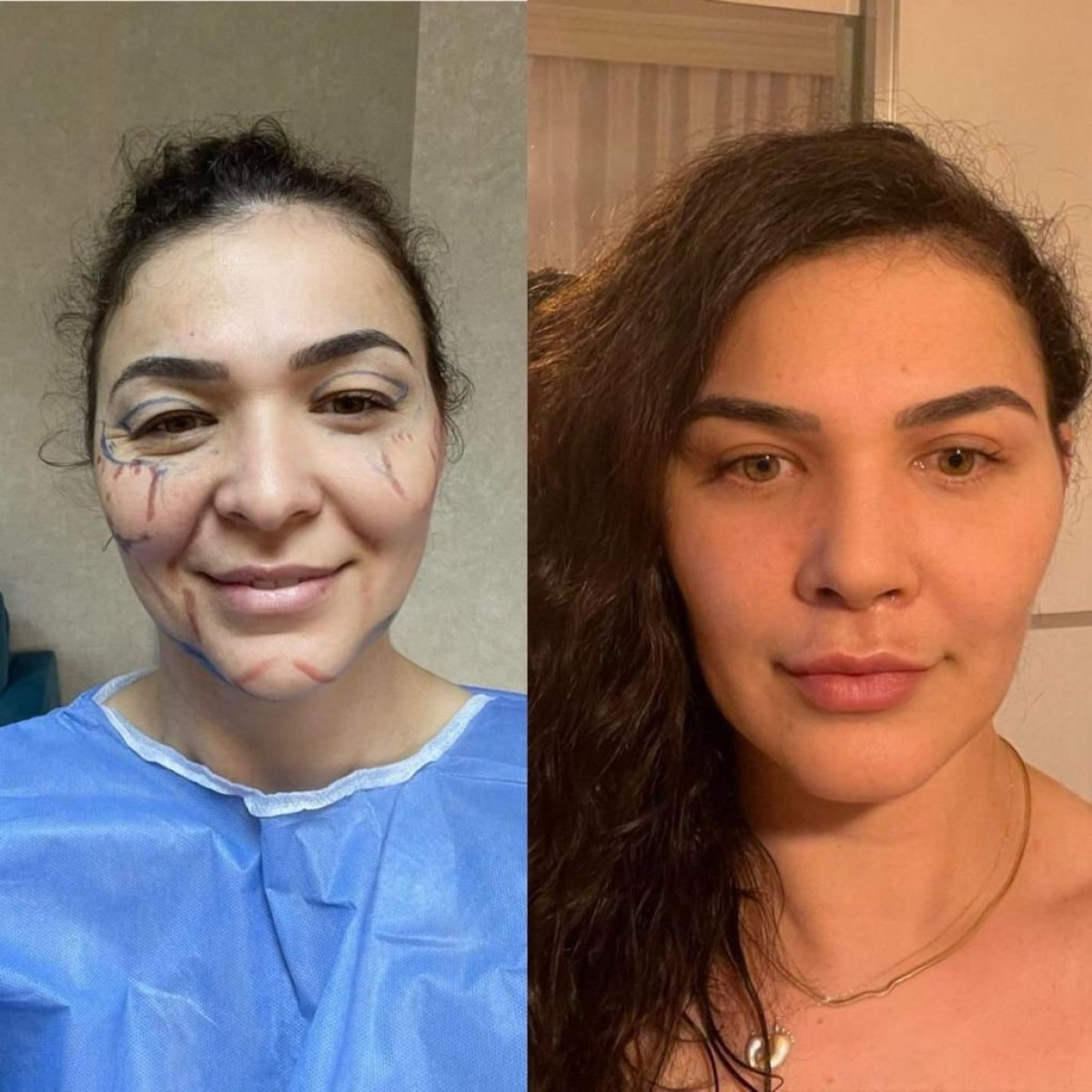 نتائج عملية الجفن العلوي قبل وبعد في عيادة Dr. Safa Manav، مظهر متجدد