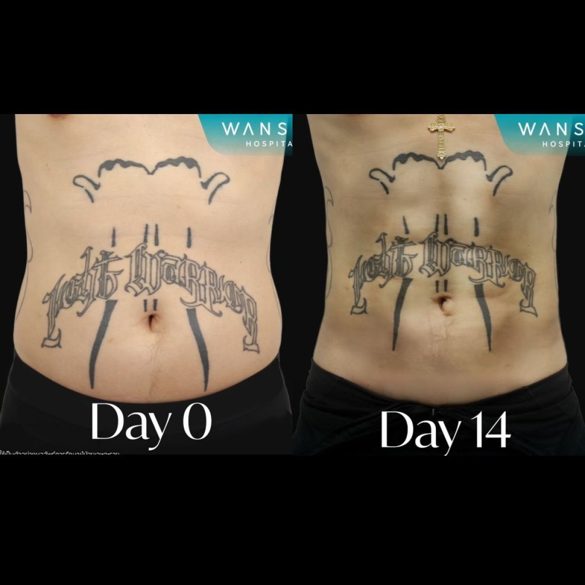 Результати до і після Vaser ліпосакції у Wansiri Hospital, помітний контур живота