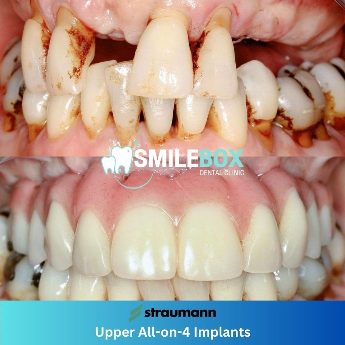 Résultat avant/après implants All-on-4 supérieurs à SmileBox Dental Clinic Thonglor