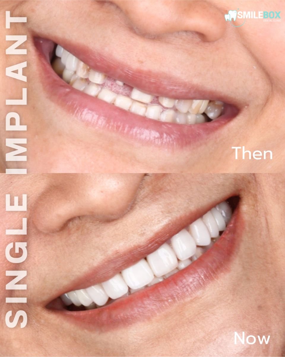 Résultat avant et après implant dentaire à SmileBox Dental Clinic - Thonglor, sourire amélioré