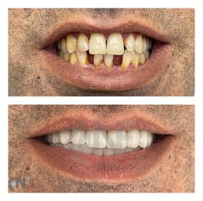 24 Zirconia Crowns with Digital Smile Design — 4-Star Hotel & VIP Transfer - photo 4