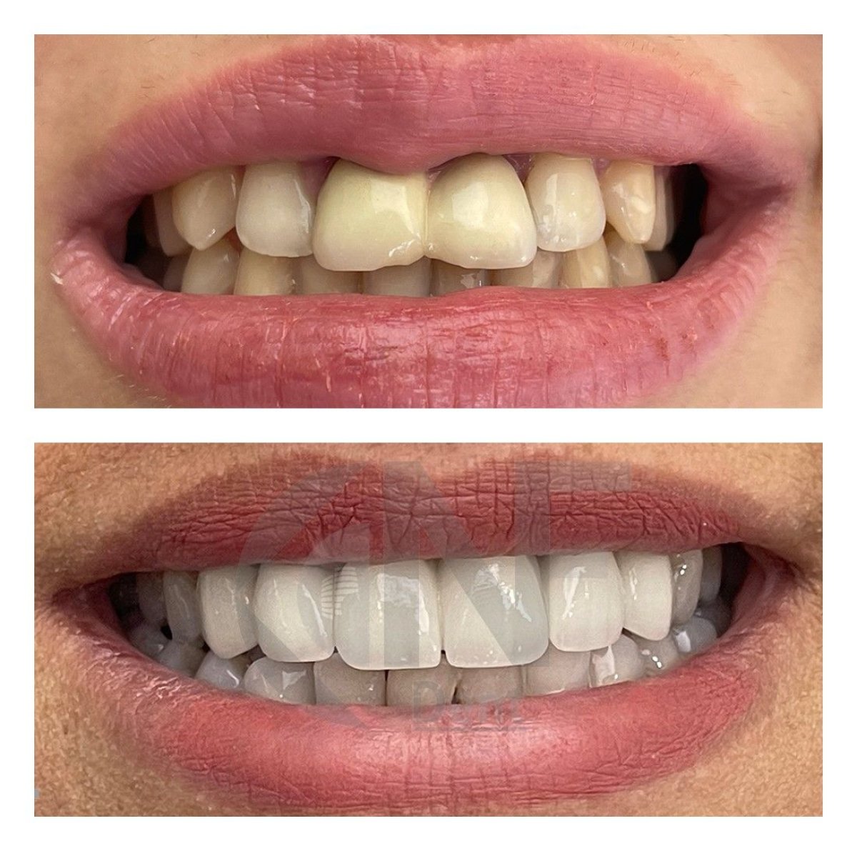 قبل وبعد قشور الأسنان في Nifa Dent International، نتيجة تجميل الابتسامة