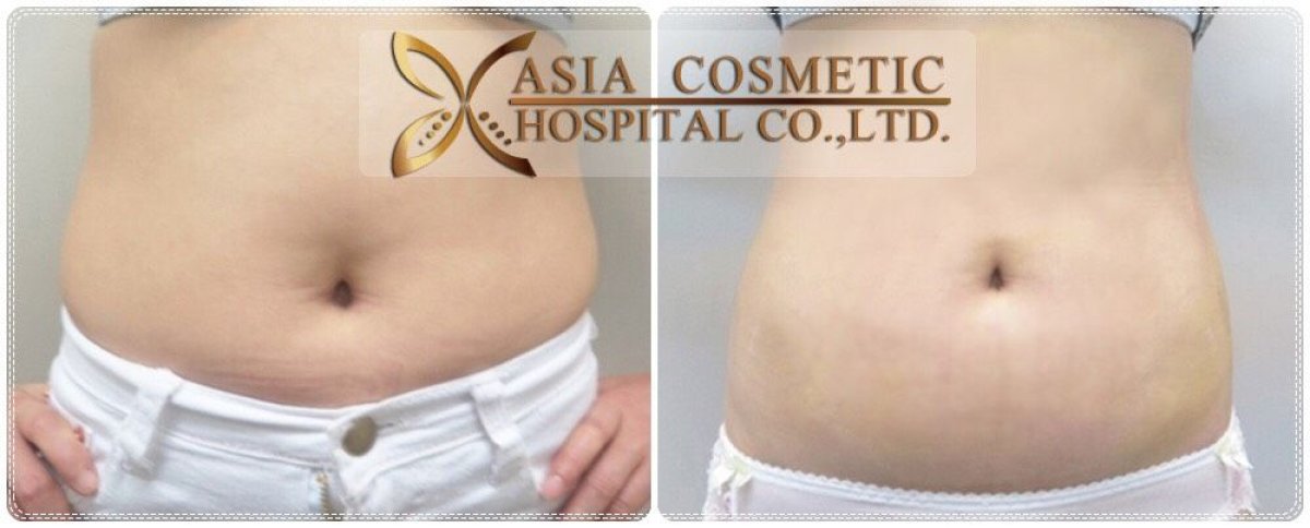 Before and after liposuction results at Asia Cosmetic Hospital, visible abdominal contouring