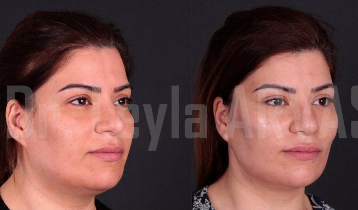 Before and after deep plane facelift result at Quartz Hospital, visible facial contour improvement