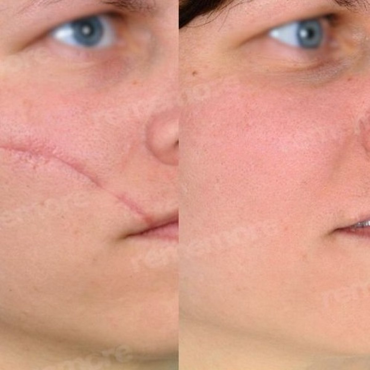 Résultats avant/après révision des cicatrices du visage à Memorial Şişli Hospital